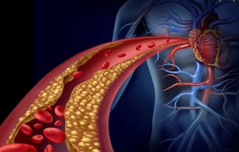 Arterioskleroza Apo Ateroskleroza Simptomat Shkaqet Dhe Trajtimi Me