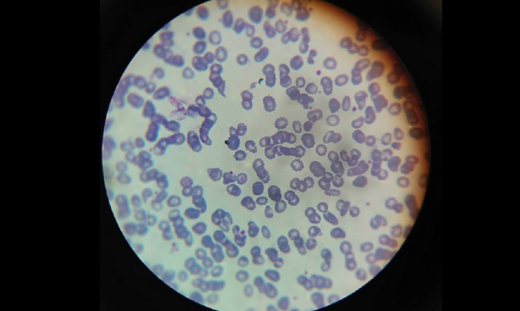 hemoglobinopatite