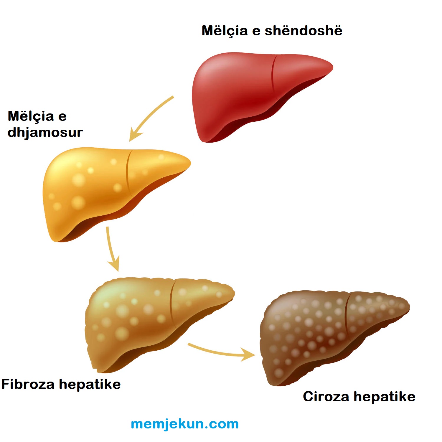 fibroza hepatike