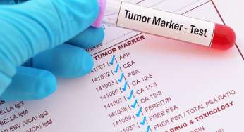 LISTA/ Shënuesit e tumorit (tumor marker), si ti dallojmë për kë lloj bëhet fjalë?