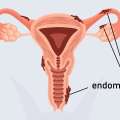 endometrioza