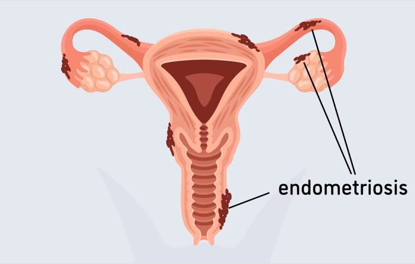 endometrioza