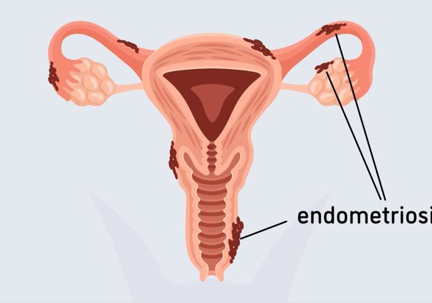 endometrioza